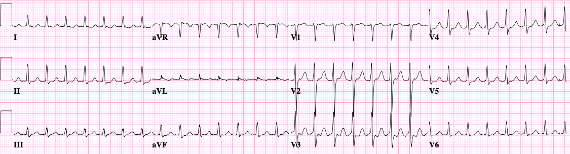 ECG tracing: svt.png
